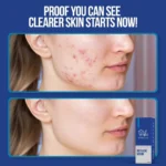 Wiki Anti Acne Serum 30ml front view
