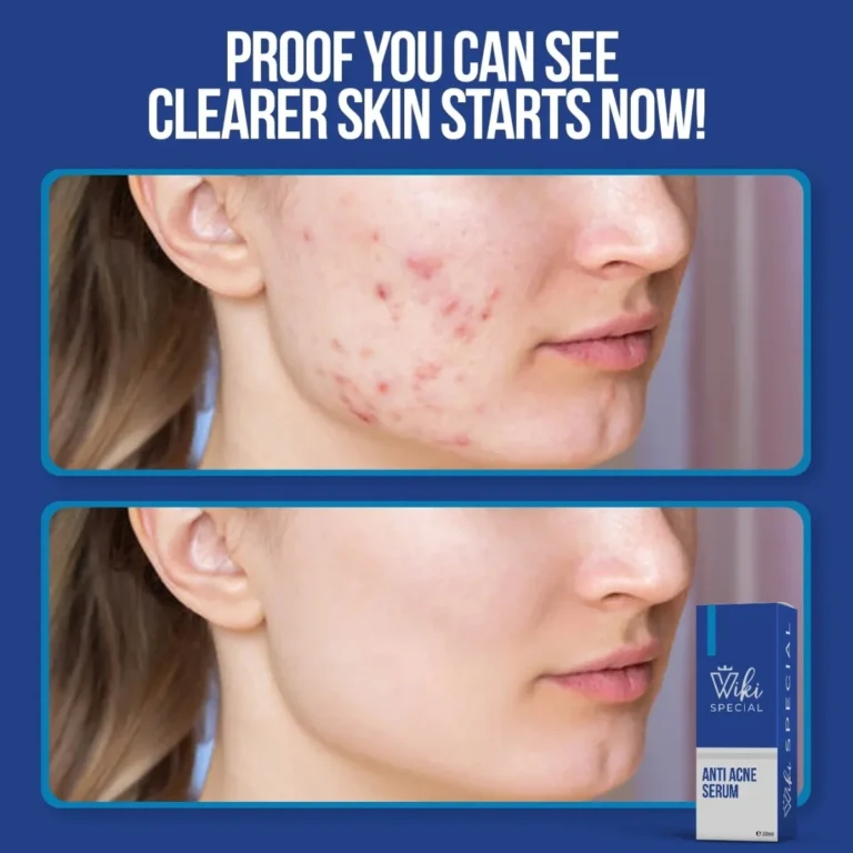 Wiki Anti Acne Serum 30ml front view